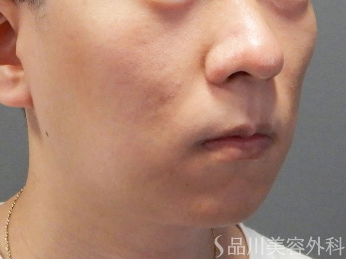 症例NO.73628のBEFORE写真
