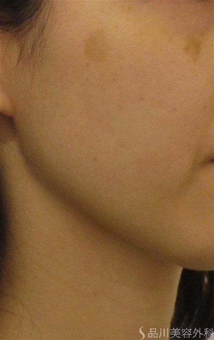 症例NO.58871のBEFORE写真