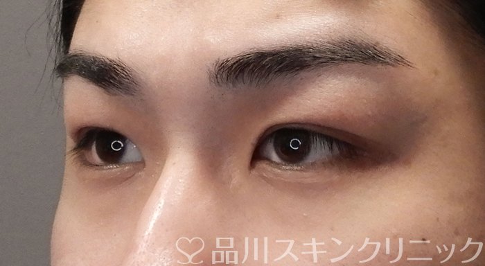 症例NO.70244のBEFORE写真