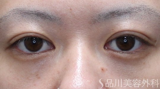 症例NO.74948のAFTER写真