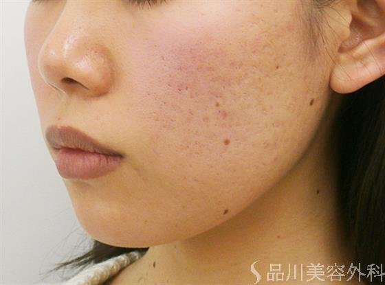 症例NO.24848のBEFORE写真