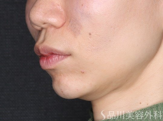 症例NO.73125のAFTER写真