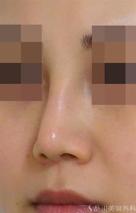 症例NO.44042のAFTER写真