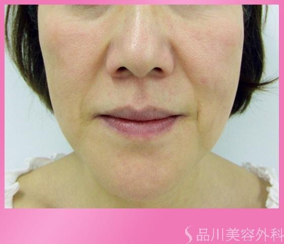 症例NO.1173のBEFORE写真