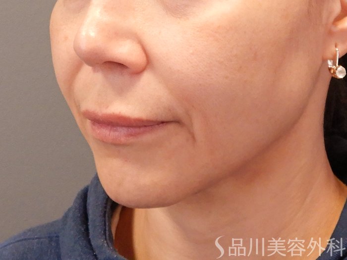 症例NO.69871のBEFORE写真