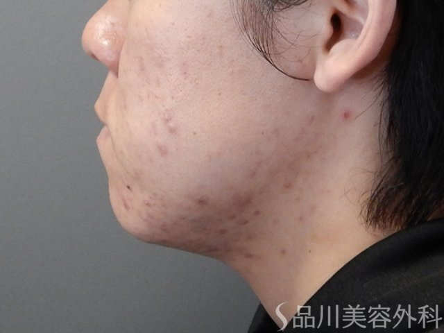 症例NO.69826のBEFORE写真