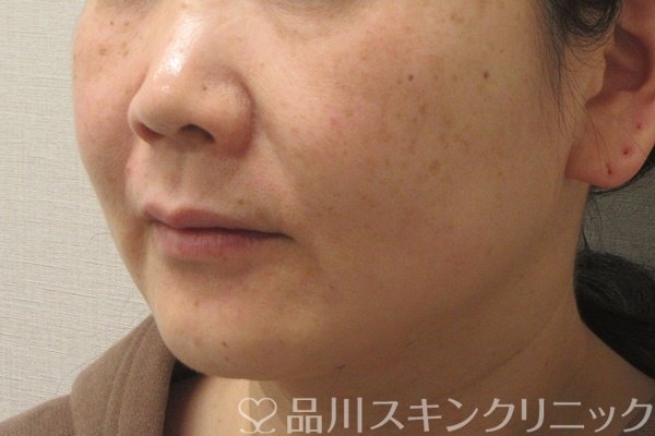 症例NO.74163のBEFORE写真