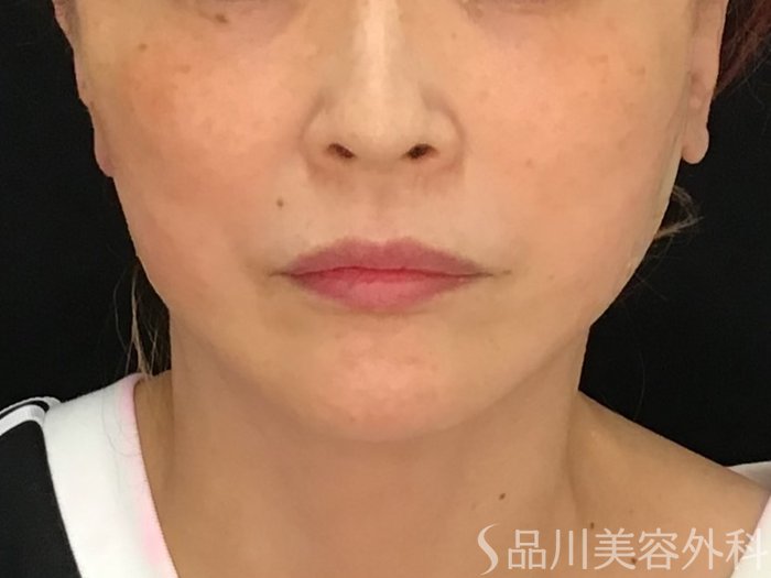 症例NO.69985のAFTER写真