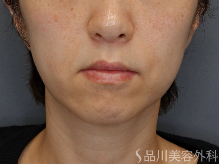 症例NO.72772のBEFORE写真