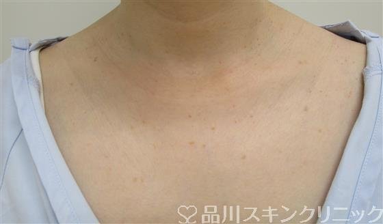 症例NO.36551のAFTER写真