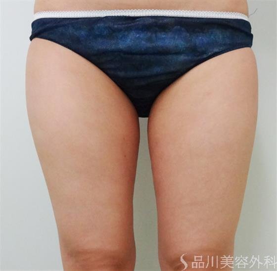 症例NO.23696のAFTER写真