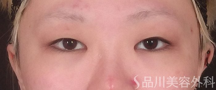 症例NO.70952のBEFORE写真