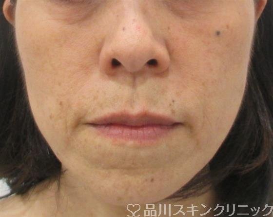 症例NO.30069のAFTER写真