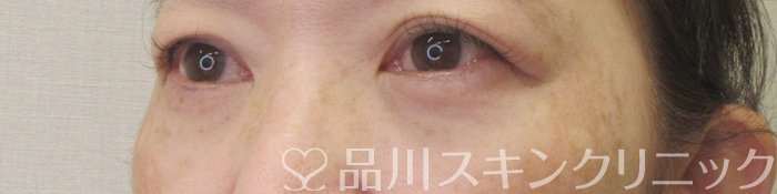 症例NO.71297のAFTER写真