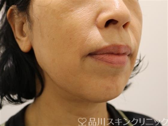 症例NO.43557のAFTER写真