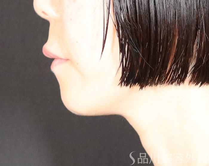 症例NO.74262のBEFORE写真