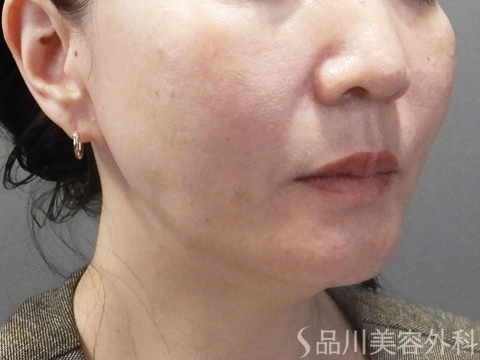 症例NO.72530のBEFORE写真