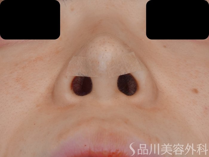 症例NO.70387のAFTER写真