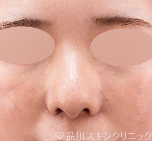 症例NO.62702のAFTER写真