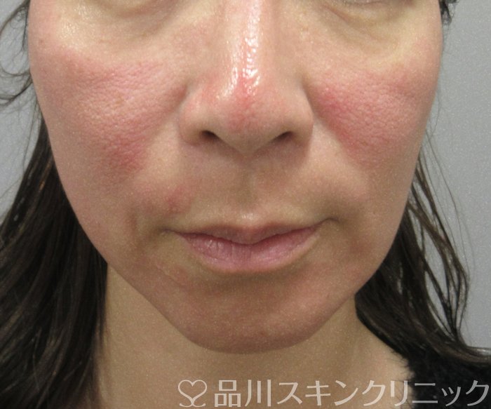 症例NO.74197のBEFORE写真