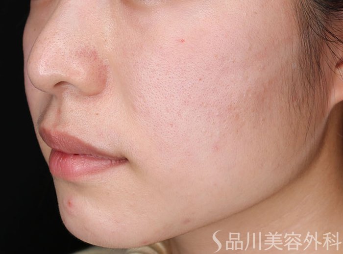 症例NO.72552のBEFORE写真