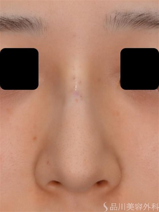 症例NO.51739のAFTER写真