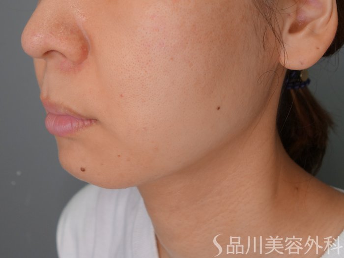 症例NO.70584のBEFORE写真