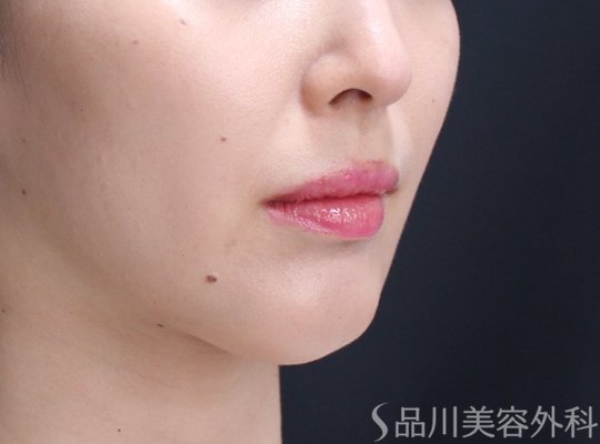 症例NO.71719のAFTER写真