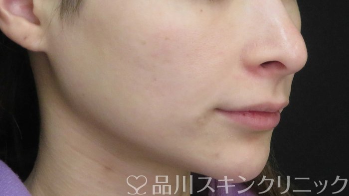 症例NO.71198のBEFORE写真