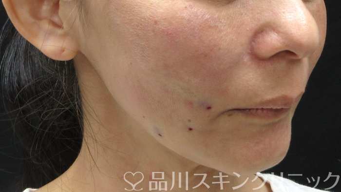 症例NO.69767のAFTER写真
