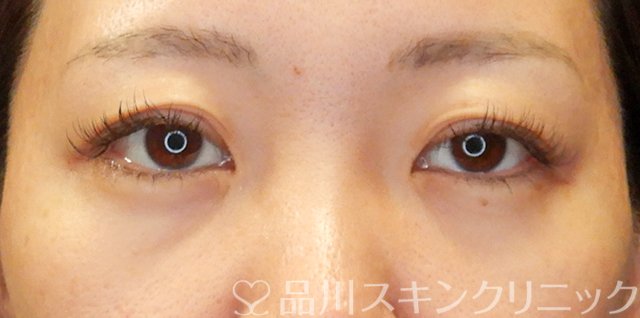 症例NO.66571のBEFORE写真