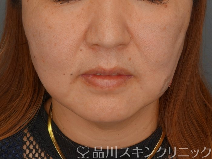 症例NO.75278のAFTER写真