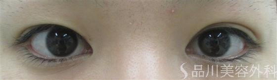 症例NO.16792のBEFORE写真