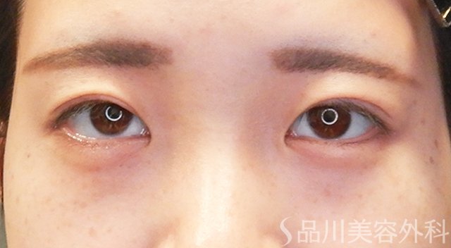 症例NO.65535のAFTER写真