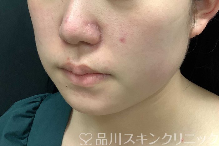 症例NO.69778のBEFORE写真