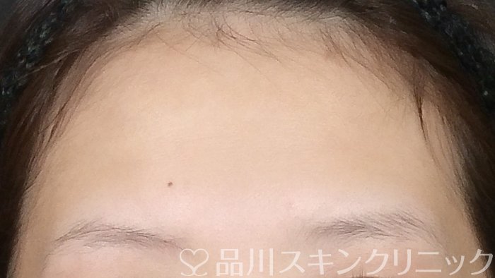 症例NO.72331のBEFORE写真