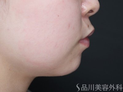 症例NO.69966のBEFORE写真