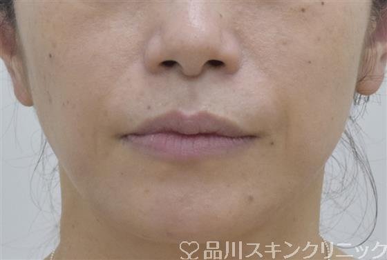 症例NO.53406のBEFORE写真