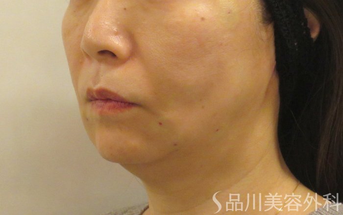 症例NO.72764のAFTER写真