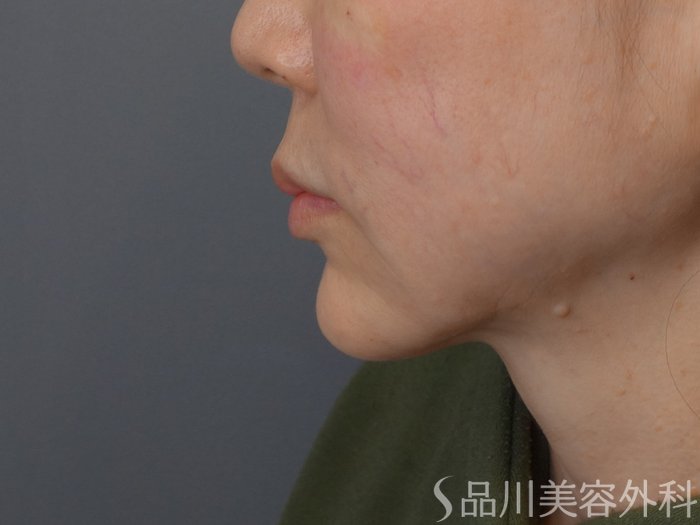 症例NO.72649のAFTER写真