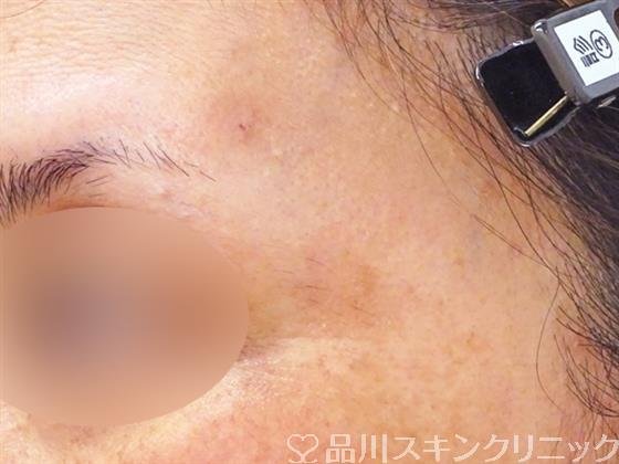 症例NO.51022のAFTER写真
