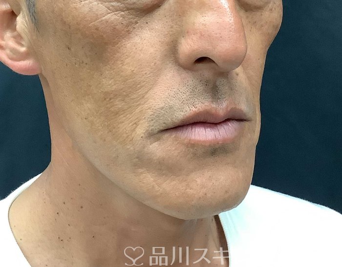 症例NO.71042のBEFORE写真