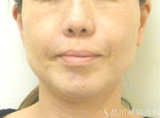 症例NO.39510のAFTER写真