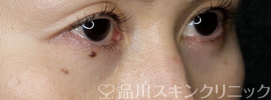症例NO.71130のAFTER写真
