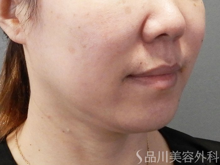 症例NO.70960のBEFORE写真