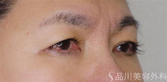 症例NO.51173のBEFORE写真