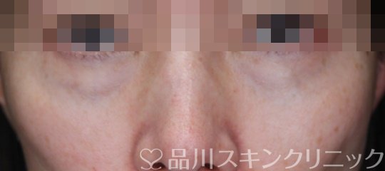 症例NO.70299のBEFORE写真