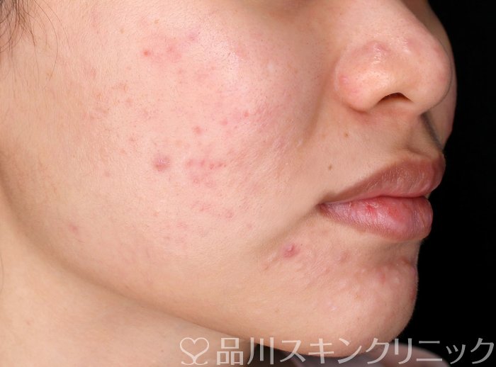 症例NO.72456のBEFORE写真