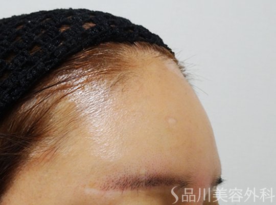 症例NO.69637のBEFORE写真