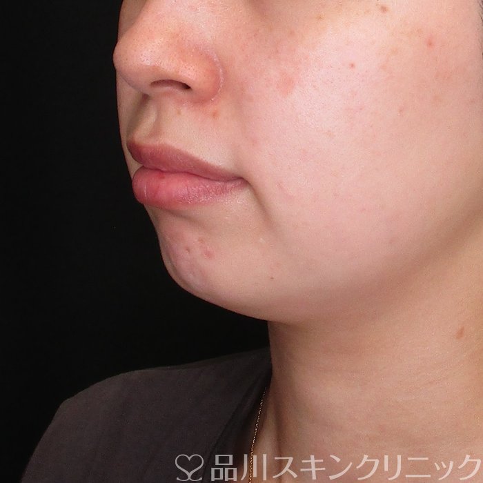 症例NO.74296のBEFORE写真